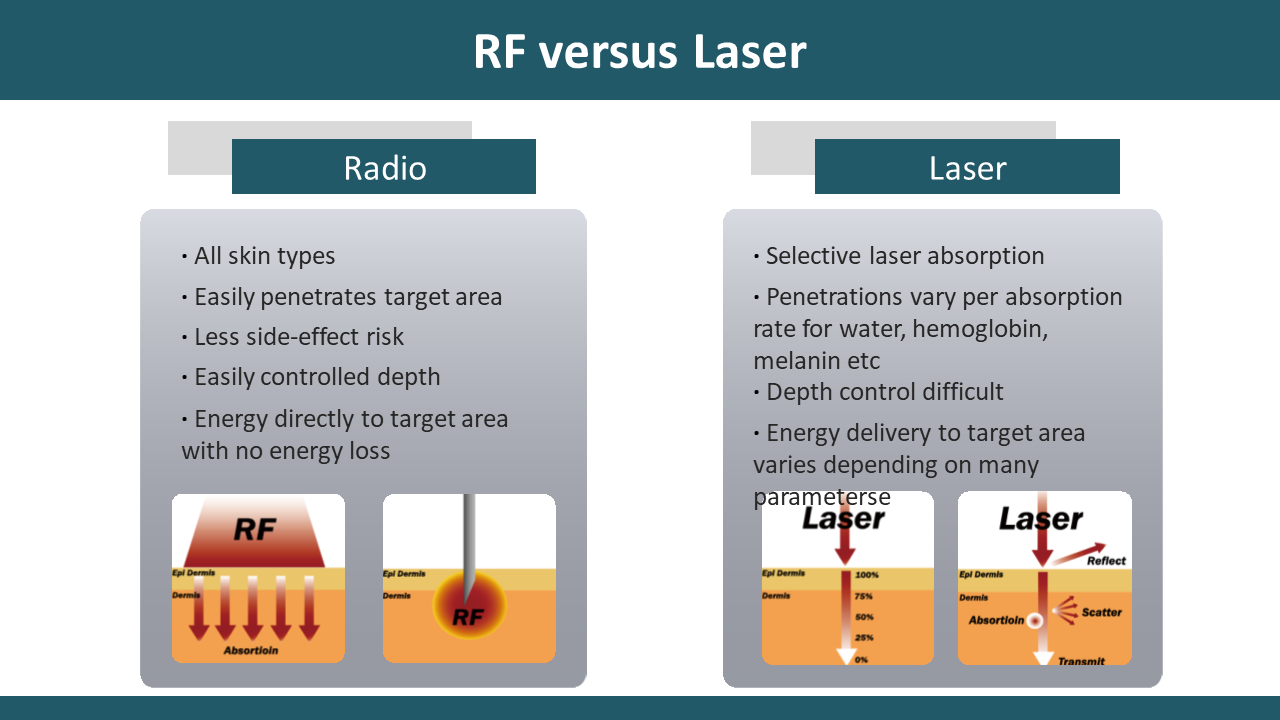 rf vs laser