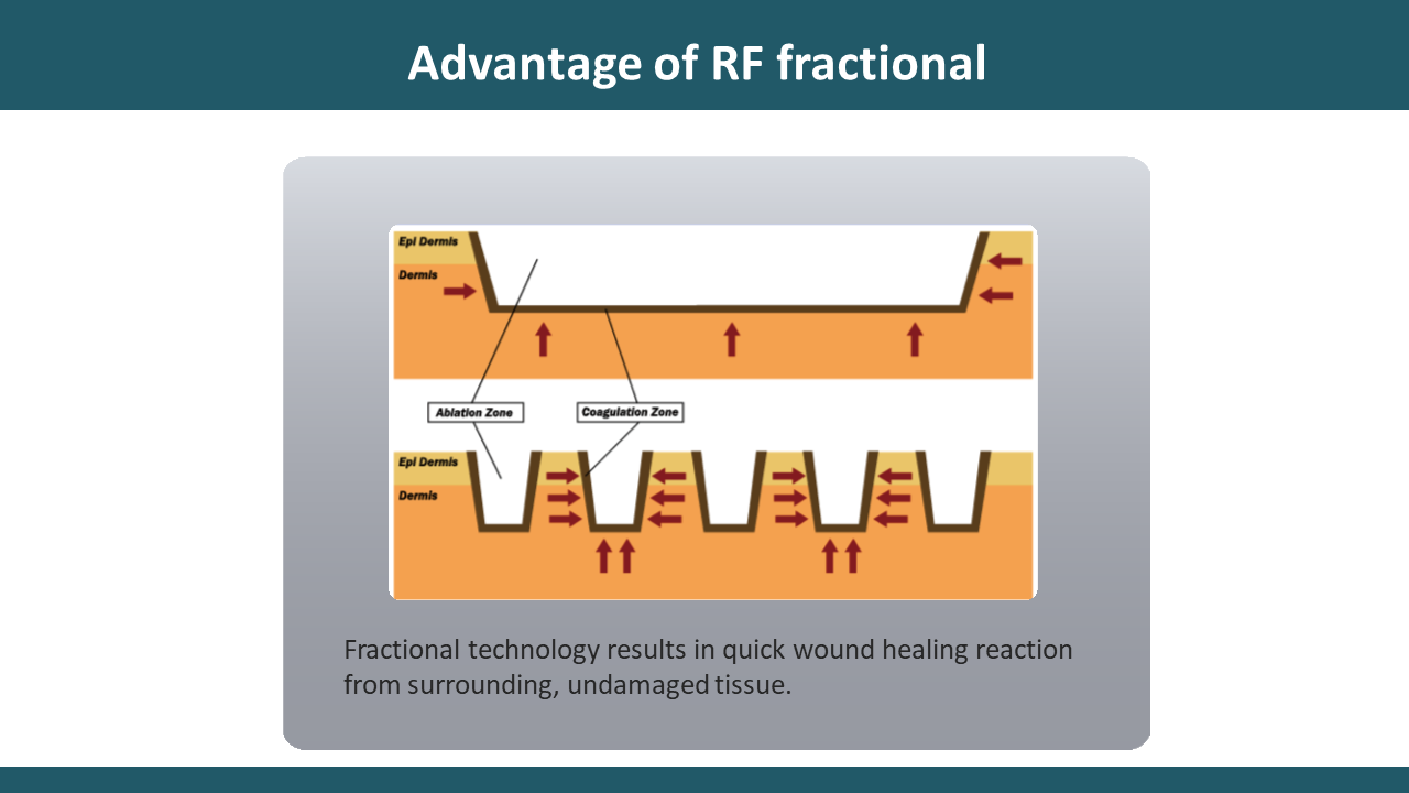 advantages of rf fractional