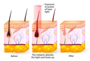 laser hair removal process